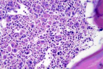 1 de abril: Día Nacional del Donante de Médula Ósea